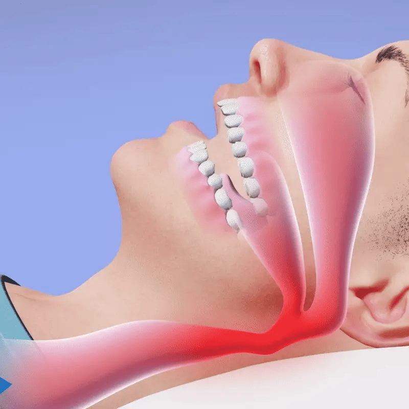 Noronca™ - Boquilla Anti-Ronquidos